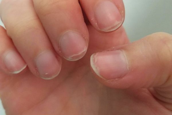 Ongles Qui Se Dédoublent : Causes et Remèdes.