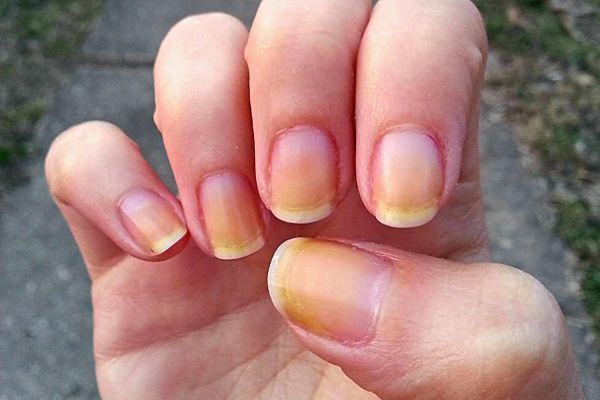 Ongle Jaune : Quels Causes et Traitements Efficaces