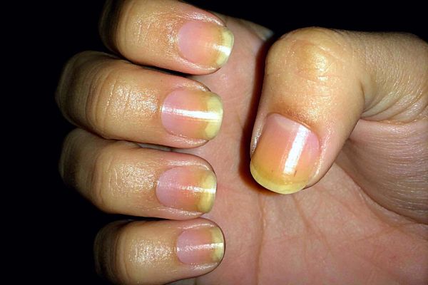 Ongle Jaune : Quels Causes et Traitements Efficaces