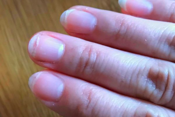 Ongles Qui Se Dédoublent : Causes et Remèdes.