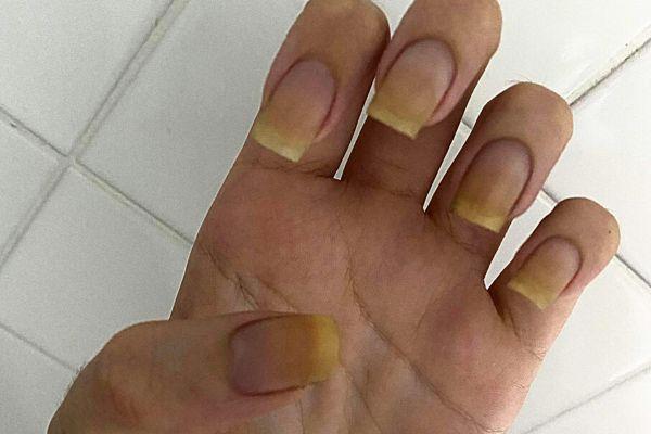 Ongle Jaune : Quels Causes et Traitements Efficaces