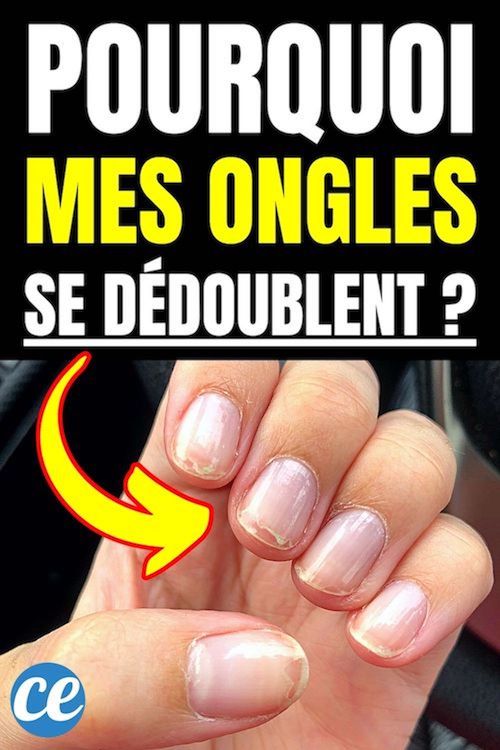 Ongles Qui Se Dédoublent : Causes et Remèdes.