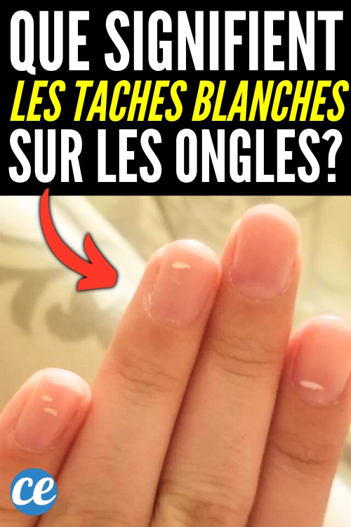 Taches Blanches Sur les Ongles Causes et Remèdes. — free download