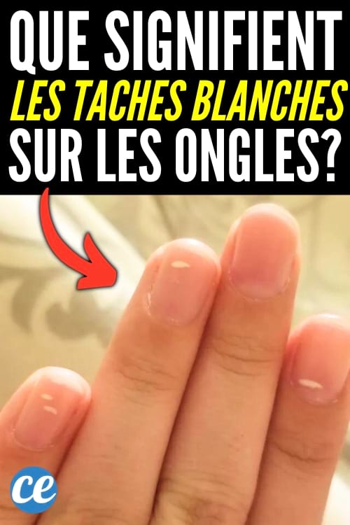Quelles sont les causes des taches blanches sur les ongles, aussi appelées leuconychie ?