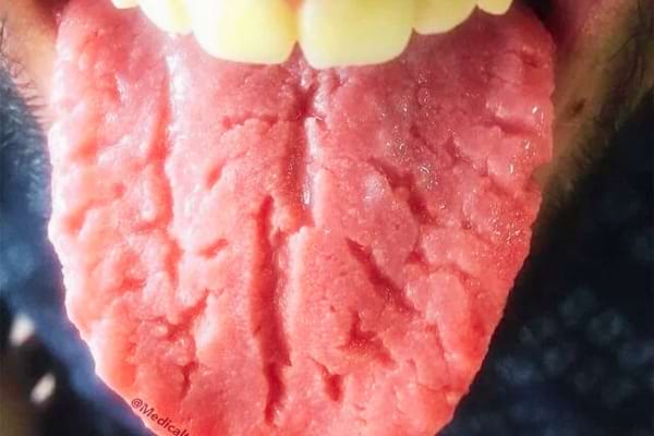 Une langue fissurée 