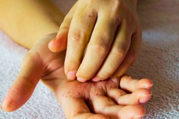 Une main gauche qui gratte à cause d'affections