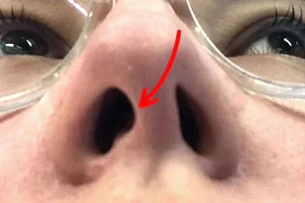 Le nez d'une personne avec des lunettes transparentes qui a une déviation de la cloison nasale