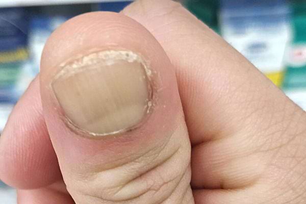 Taches Blanches Sur Les Ongles Causes Et Rem Des