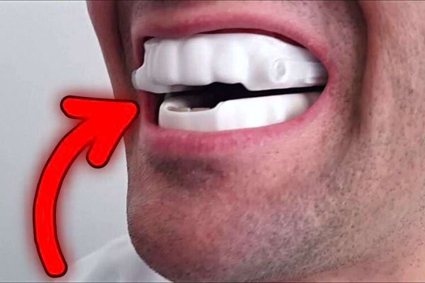 Une homme ayant une orthèse d’avancée mandibulaire dans la bouche 