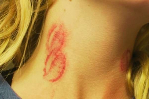 Plusieurs suçons présents dans le cou d'une femme