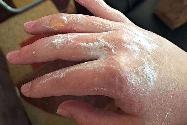 Une main brûlée avec de la crème