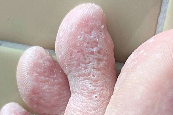 Des doigts de pieds avec mycose 