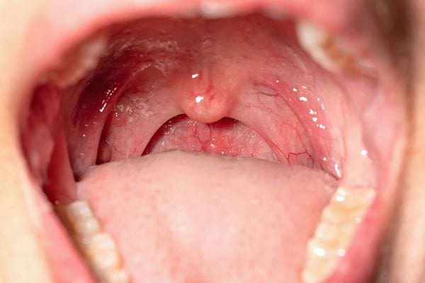 La vue de près d'une gorge de la bouche ouverte d'une personne