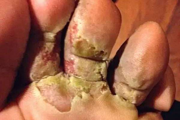 Un pied ayant de la moisissure sous les orteils 