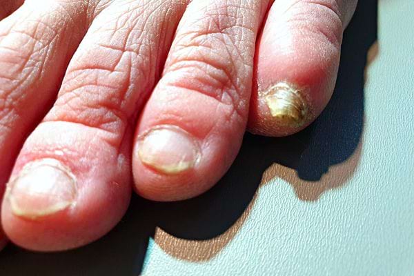 Un pied avec des ongles abîmés 