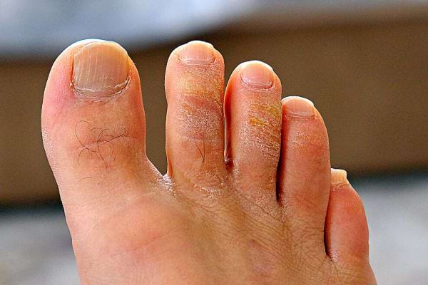 Un pied avec des mycoses 