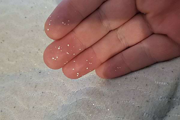 Des oeufs de punaises de lit sur les doigts d'une main