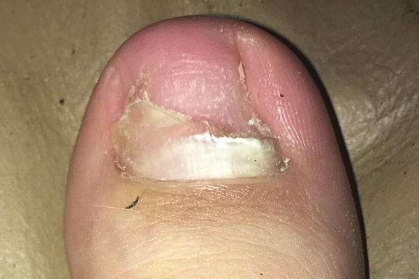 Un gros orteil de pied avec l'ongle à moitié cassé 