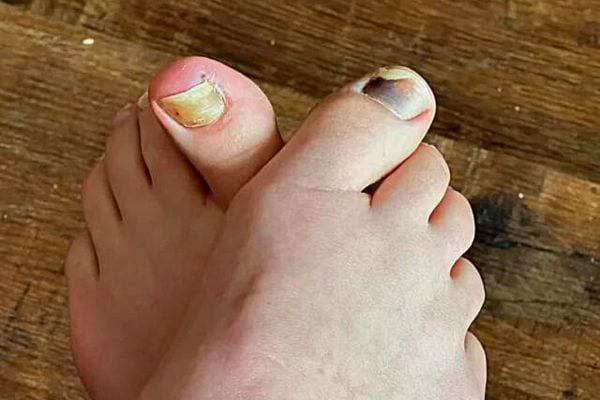 Deux gros orteils de pieds avec des mycoses 