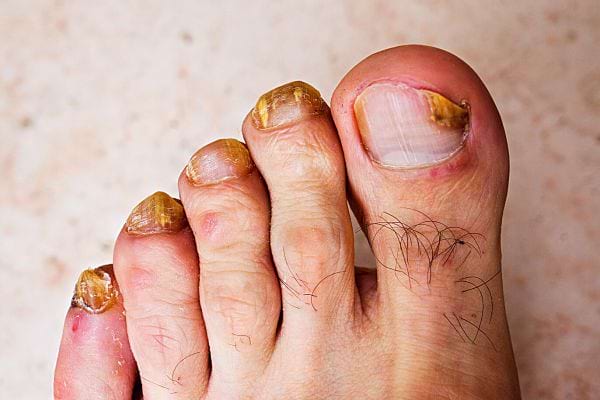 Des ongles de pieds avec mycose 