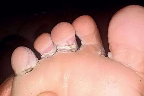 Un pied avec des mycoses en dessous les orteils 