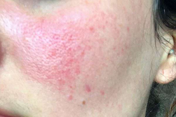 Le visage d'une femme avec des rougeurs