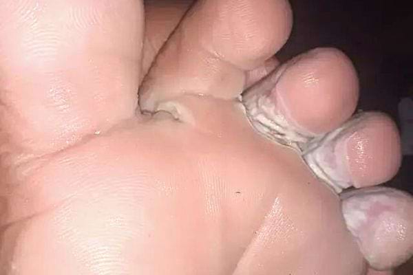 Des mycoses en dessous des orteils de pied  