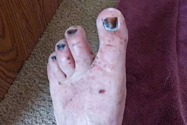 Un pied avec les ongles noirs 