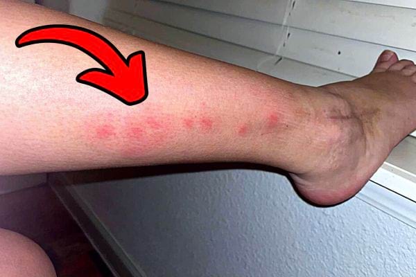 Une jambe avec des piqûres de punaises de lit dessus