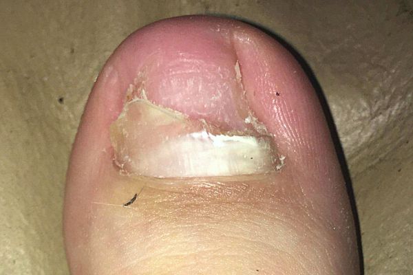 Mycose de Pieds : 4 Traitements au Bicarbonate de Soude.