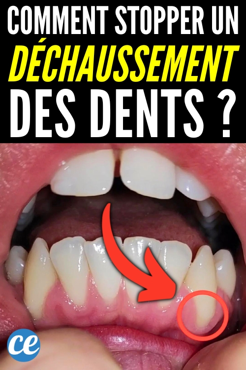 Déchaussement des Dents 12 Remèdes de GrandMère Efficaces.