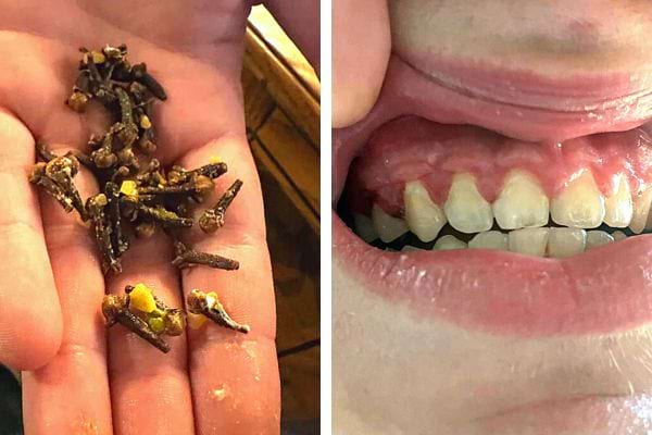 Des clous de girofle pour les gencives 