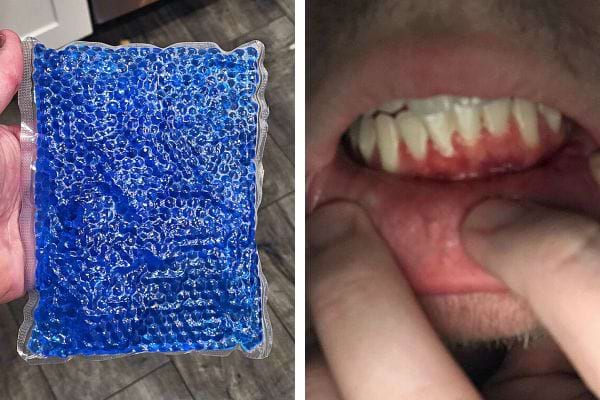 Une compresse bleue pour les gencives 