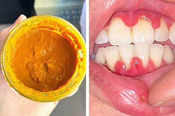 Du gel de curcuma pour les gencives 
