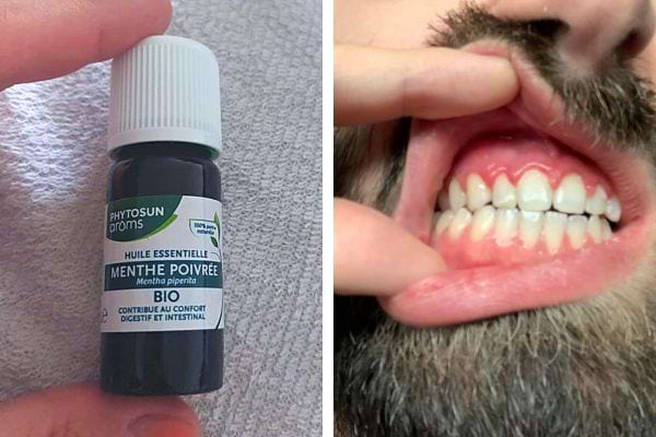 De l'huile essentielle de menthe poivrée pour les gencives 