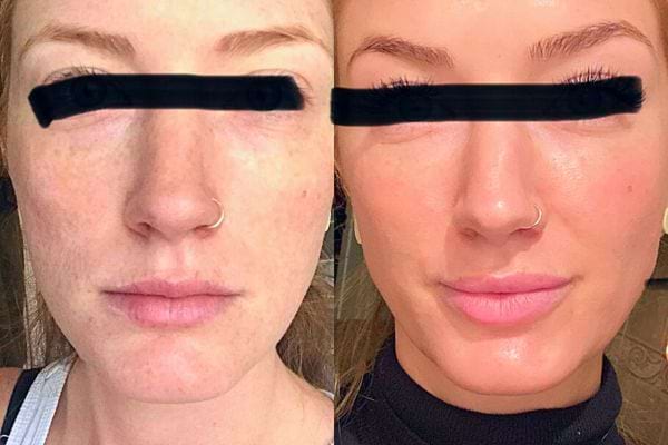 Transformation du visage d'une femme avant et après l'application de vitamine E.
