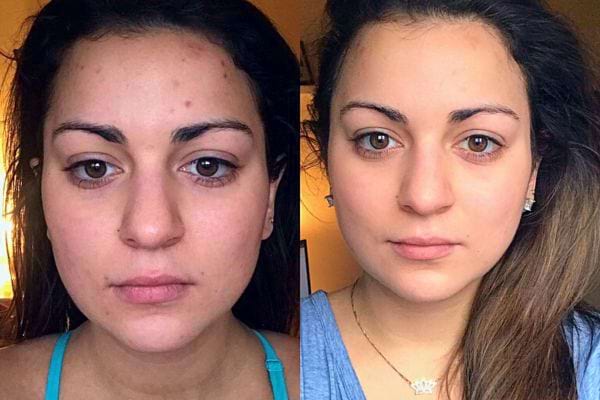 Amélioration visible de l'acné chez une femme grâce à la vitamine E.