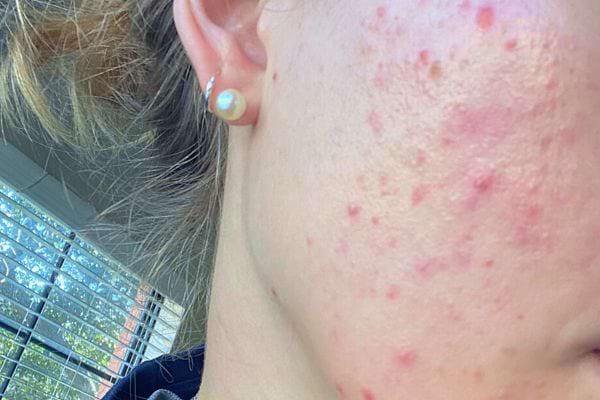 Peau plus douce et hydratée chez une femme après utilisation de vitamine E.