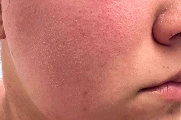 Réduction des rougeurs et peau apaisée chez une femme avec vitamine E.