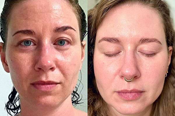 Visage d'une femme montrant un teint équilibré après traitement à la vitamine E.