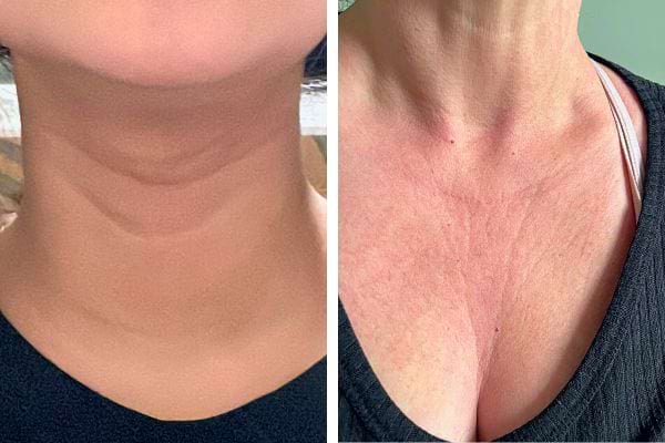 Image d'un cou sans rides suivi d'un décolleté présentant des signes de vieillissement cutané.