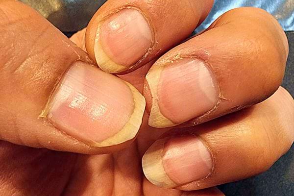 Ongles moyennement longs avec des signes de cassures sur une main à la peau claire.