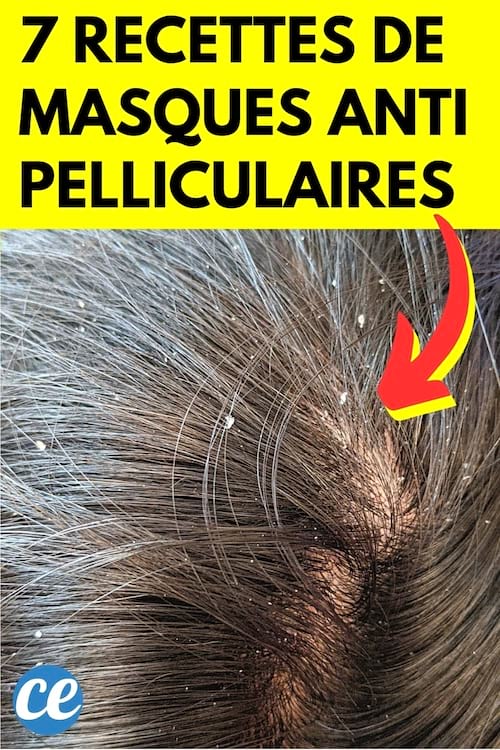 Des pellicules en gros plan sur le cuir chevelu d'une femme