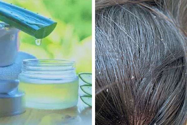 Aloe vera, traitement naturel contre les pellicules : Gel d'aloe vera et cheveux présentant des pellicules.