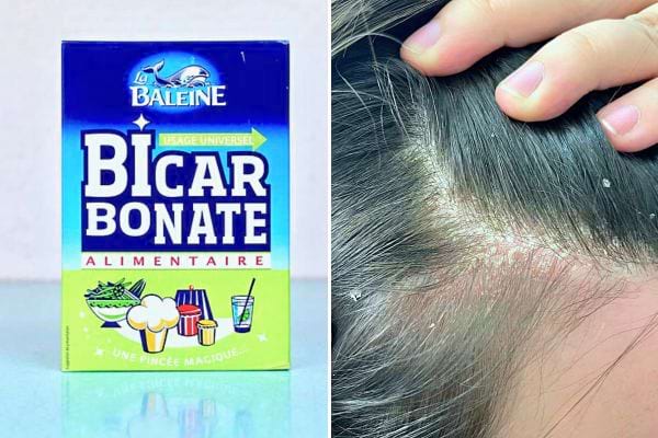 Une boîte de bicarbonate de soude à côté d'une chevelure parsemée de pellicules.