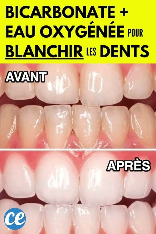Blanchir ses Dents avec du Bicarbonate et l