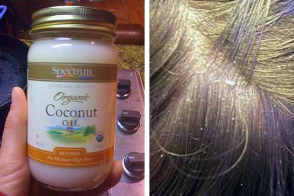 Huile de coco pour nourrir le cuir chevelu : Pot d'huile de coco organique et cheveux avec pellicules.