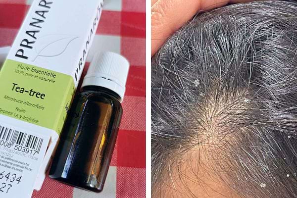 Huile essentielle d'arbre à thé pour apaiser le cuir chevelu : Flacon d'huile essentielle de tea-tree et cheveux avec pellicules.
