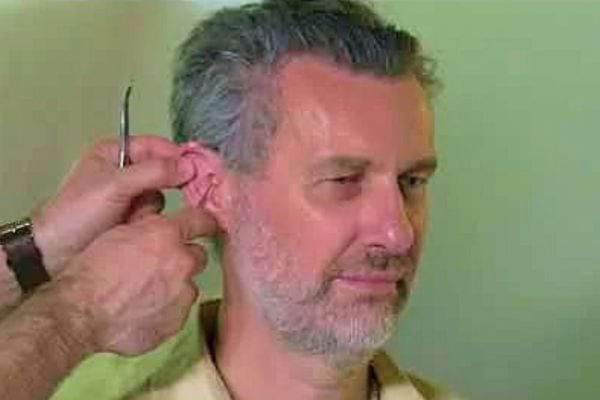 Homme recevant un traitement par acupuncture derrière l'oreille.