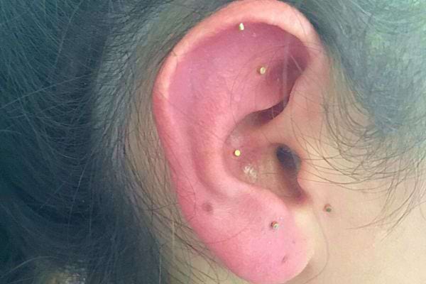 Oreille avec plusieurs points d'acupuncture marqués par de petites billes dorées.
